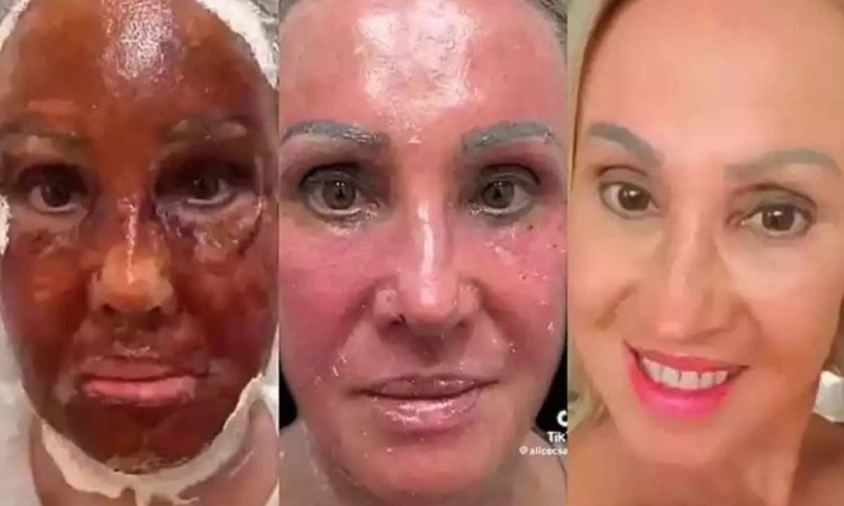 Peeling de fenol: Anvisa proíbe a substância no país. Entenda como fica o procedimento agora?
